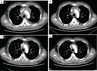 2-Year survival benefit from immunotherapy for squamous cell cancer with cancer of unknown primary in mediastinum: a case report